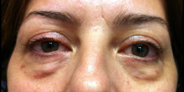 dra_estrella_fernandez_palma_parpados_ojos_bolsas_blefaroplastia_antes_061