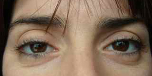 dra_estrella_fernandez_palma_parpados_ptosis_conjuntivomullerectomia_antes_cirugia1